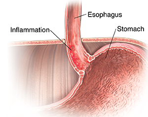 Cross section of lower esophagus showing Barrett's esophagus.