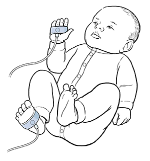 Baby with oxygen sensors wrapped around a hand and foot.