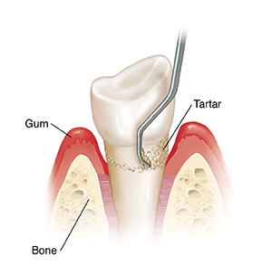 Side view of tooth in bone showing instrument doing planing.