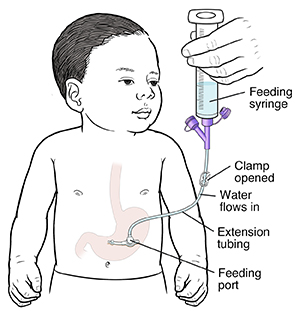 Outline of baby with tube inserted in stomach. Feeding port is near skin, and clamp is open on extension tubing. Feeding syringe is inserted into extension tubing. Water flows into baby's stomach.