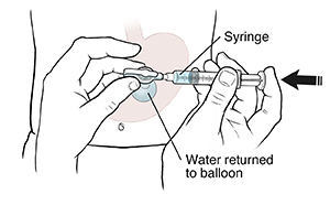 Front view of abdomen showing gastrostomy tube, balloon, and syringe. Hands holding syringe in gastrostomy tube, pushing plunger to fill balloon with water.