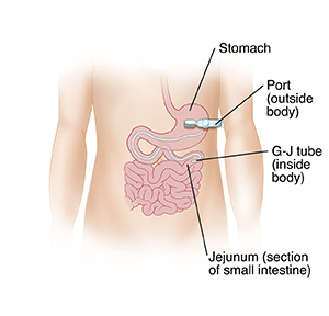 Front view of abdomen showing G-J tube inserted through body wall into stomach with tube going into small intestine.