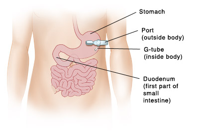 Vista frontal del abdomen de un niño con una sonda de gastrostomía insertada a través de la pared del cuerpo hacia el interior del estómago.