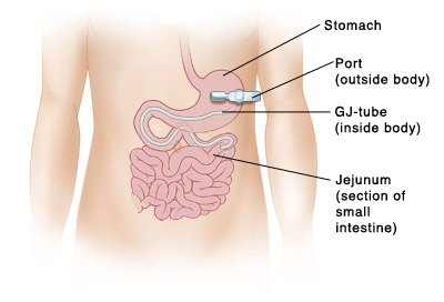 Vista frontal del abdomen de un niño con una sonda de gastroyeyunostomía insertada a través de la pared del cuerpo hacia el interior del estómago. La sonda ingresa en el intestino delgado.