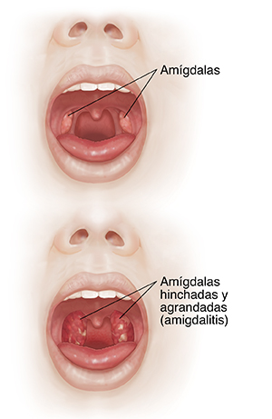 Vista frontal de una cara con la boca abierta donde se compara la cavidad bucal y las amígdalas con una garganta inflamada y amígdalas agrandadas.