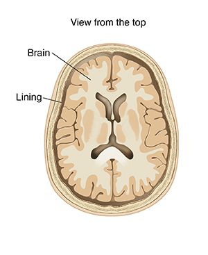 3-89205 Ilustración de la meningitis Ilustración médica Vista superior de un corte transversal del cerebro donde puede verse la membrana.