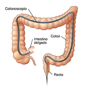 Vista frontal del colon donde puede verse un endoscopio insertado a través del ano y dentro de todo el colon.