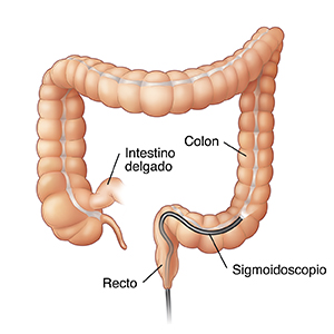 Vista frontal del colon donde puede verse un endoscopio insertado a través del ano y dentro del colon sigmoide.