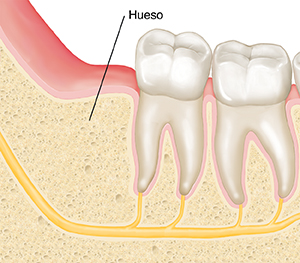 Primer plano de corte transversal de maxilar y molares en el que se muestra el lugar de donde se extrajo una muela de juicio.
