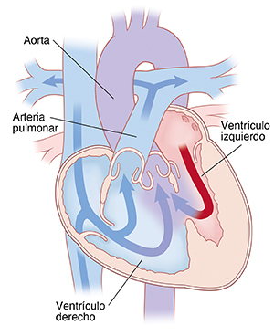 Vista de las cuatro cavidades del corazón, donde se observa la doble salida de ventrículo derecho. Las flechas indican que la sangre fluye desde el ventrículo derecho hasta la arteria pulmonar y la aorta.