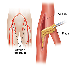 Arteria femoral donde se observa una incisión con un instrumento que extrae la placa. Un localizador muestra la posición de las arterias femorales.
