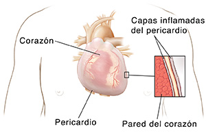Contorno de un torso humano, donde se ve el corazón y el pericardio. Primer plano de un corte transversal en el que pueden verse dos capas de pericardio inflamado con líquido entre ellas, encima de la pared del corazón.