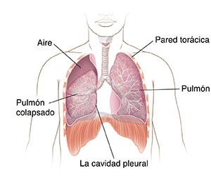 Vista frontal del pecho de un hombre con el pulmón derecho parcialmente colapsado.