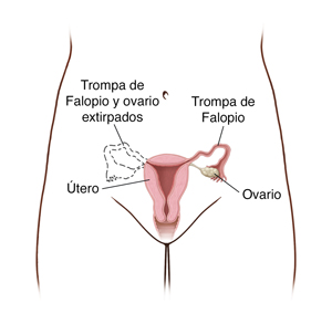 Pelvis femenina donde se observan los órganos reproductores. Las líneas de puntos muestran la extirpación de la trompa de Falopio y del ovario en un lado.