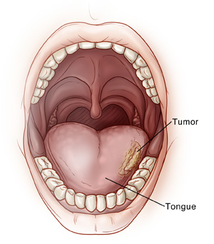 Front view of an open mouth with a tumor on the side of the tongue.