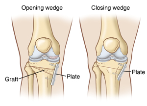 Front view of bony structures of two knees showing closed wedge and open wedge osteotomy.