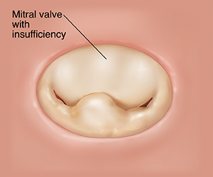 Top view of closed mitral valve with insufficiency.