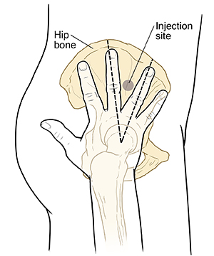 Outline side view of lower body, hip, and thigh with pelvic and leg bones showing. Hand with fingers spread is palm down where leg bone meets hip. Dotted line around circle between two middle fingers.