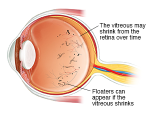 Three-quarter view of cross-sectioned eye showing shrinking vitreous and floaters.