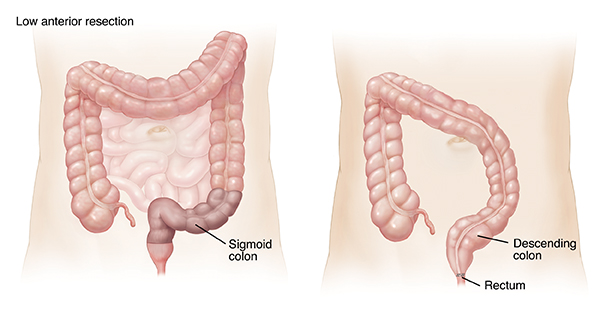 Outline of adult abdomen showing large and small intestines. Shaded area on sigmoid colon and rectum shows low anterior resection. Outline of adult abdomen showing descending colon attached to rectum after low anterior resection.