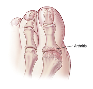 Top view of big toe showing arthritis.
