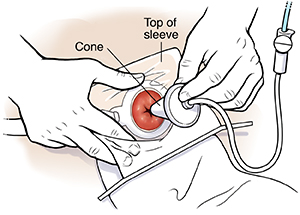 Hand inserting irrigation cone into stoma.