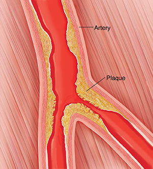 Cross section of peripheral artery with plaque buildup.