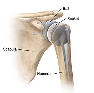 Front view of shoulder joint with total reverse shoulder replacement.