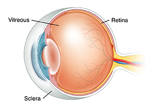Three-quarter view of cross-sectioned eye showing vitreous.