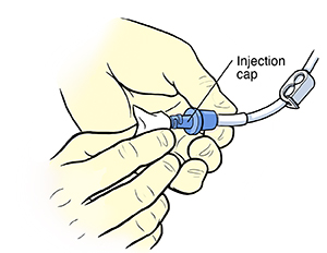 Gloved hands using alcohol wipe to clean injection cap of PICC line.