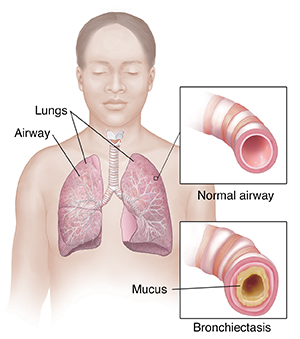 Front view of respiratory system with detail of normal airway and airway with bronchiectasis.