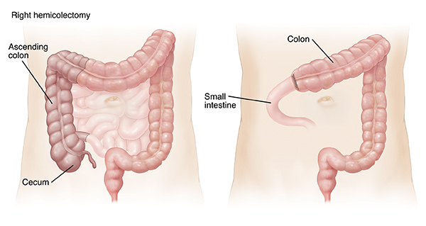 Outline of adult abdomen showing large and small intestines. Shaded area on right colon shows right hemicolectomy. Outline of adult abdomen showing colon and small intestine connected after right hemicolectomy.
