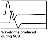 Formas de onda producidas durante el estudio de la conducción nerviosa