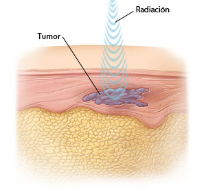 Ondas de radiación de alta energía penetran la piel para alcanzar el tumor.