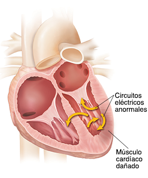 Corte transversal del corazón que muestra fibrilación ventricular.