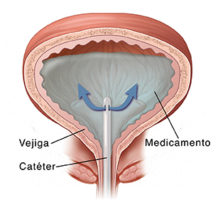 Corte transversal de vista frontal de la vejiga con un catéter insertado por el que se administra medicamento.