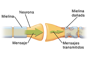 Primer plano de la sinapsis donde se encuentran dos neuronas. Las flechas muestran el mensaje que pasa por una neurona sana y se interrumpe en la neurona dañada.