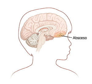 Contorno de la cabeza de un niño de lado mostrando la cabeza y el cerebro. Hay un absceso en la parte delantera del cerebro. 