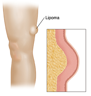 Vista lateral de una pierna con un lipoma debajo de la piel del muslo. Recuadro que muestra un corte transversal de un lipoma.