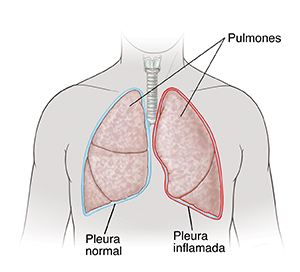 Vista frontal de cuello y pecho de un hombre donde se ve el pulmón derecho cubierto de pleura normal. El pulmón izquierdo está cubierto de pleura inflamada.