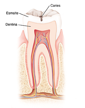 Corte transversal de un diente donde se observa caries.
