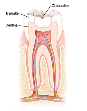 Corte transversal de un diente donde se observa un relleno.