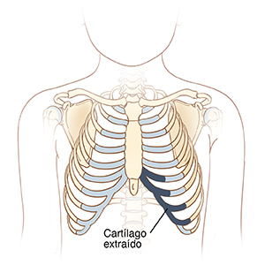 Vista frontal del torso de un hombre, en la que se observa la ubicación del cartílago que se extrae de las costillas para la reconstrucción del pabellón auricular.