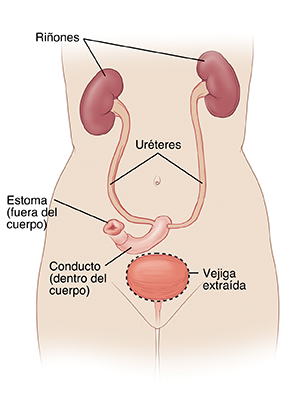 Vista delantera de un torso femenino, donde pueden verse los riñones conectados al conducto y el estoma por medio de los uréteres. Se ha extraído la vejiga.