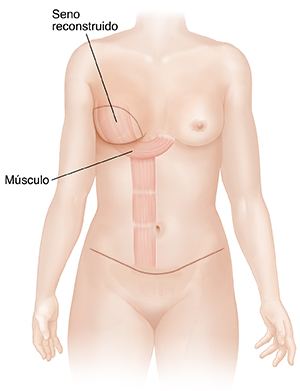 Vista frontal del pecho y el abdomen de una mujer, mostrando músculo de abdomen siendo trasladado para reconstruir un seno.