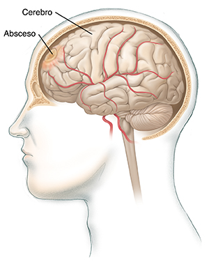 Vista lateral de una cabeza en la que puede verse un corte transversal en el cráneo donde se observa todo el encéfalo, con un absceso.