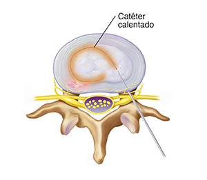 Vista superior de las vértebras lumbares y el disco donde se observa el catéter calentando el disco.