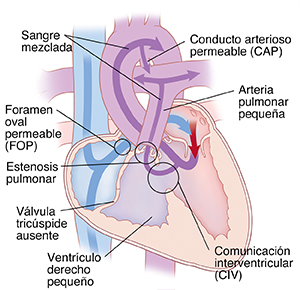 Corte transversal de vista frontal de un corazón que muestra atresia tricúspide y conducto arterioso permeable (PDA), ventrículo derecho pequeño, ausencia de válvula tricúspide, foramen oval permeable (PFO), estenosis pulmonar y comunicación interventricular (VSD). Unas flechas muestran la sangre que fluye de la aurícula derecha por el PFO a la aurícula izquierda; la sangre mezclada fluye del ventrículo izquierdo a los pulmones y el resto del cuerpo.