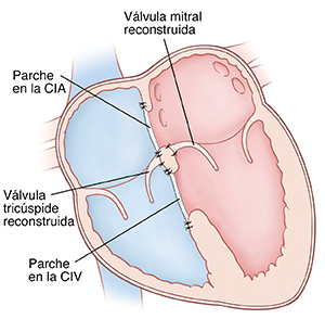 Corte transversal de vista frontal de un corazón donde pueden verse las aurículas arriba y los ventrículos abajo. Se reconstruyen las válvulas mitral y tricúspide. Se ve un parche en la comunicación interauricular (CIA) y otro en la comunicación interventricular (CIV).