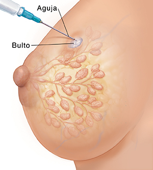Vista lateral de un seno femenino donde pueden verse los conductos y los lóbulos en imagen fantasma. Se muestra una biopsia con aguja del bulto.
